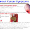 If you are diagnosed with stomach cancer, your doctor will discuss the best options to treat it. 1