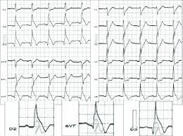 Image result for Early Repolarization
