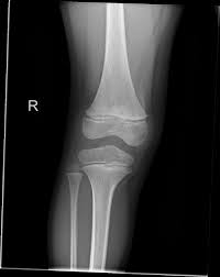 Image result for Knee XRay