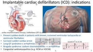 Image result for Internal Cardiac Defibrillator