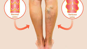 Detail of varicose veins on the leg of a seated woman. Varicose Veins Treatment And Surgical Procedure Options