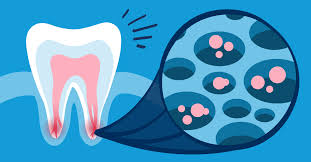 Why You Shouldn T Put Off Getting A Root Canal Procedure Gentlewave Procedure