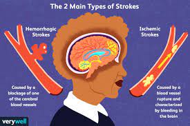 You'll also have a neurological exam to see how a potential stroke is affecting your nervous system. Stroke Causes And Risk Factors