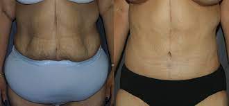 Wearing a compression garment takes a lot of guesswork out of the equation when it comes to. Fleur De Lis Tummy Tuck Post Bariatric Plastic Surgery