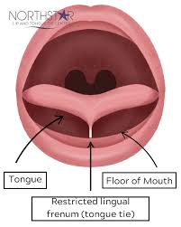 Image result for Ankyloglossia