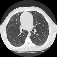 The most frequent clinical presentation is a neurovisceral infantile form in type a. Niemann Pick Disease Type B Pulmonary Findings Radiology Case Radiopaedia Org