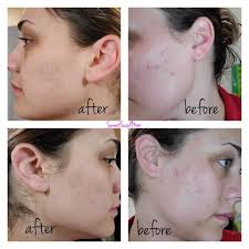 🖤 CUSTOMER RESULTS 🖤 Farmasi products used: Our burn and balance bundle  plus aloe glow… Plus 2 litres of water a day. Daily activities consisted of  dog walks chasing and feral toddlers