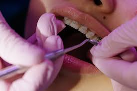 Snaggletooth | Crooked Tooth | Misaligned Tooth