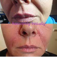 The nasolabial folds treatment will reduce the depth of smile lines to make them softer. Hyglow No Needle Flawless Beauty Clinic Normanby Ltd Facebook