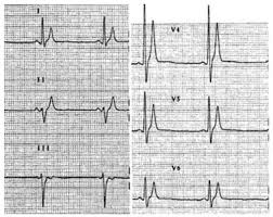 Image result for QT Interval