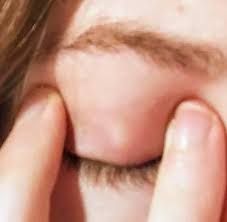 Knubbel Im Augenlid Gesundheit Augen Augenarzt