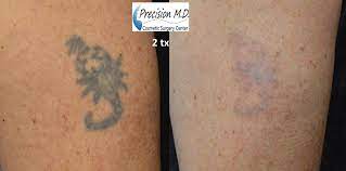 She went to get the dr. Tattoo Removal Sacramento Laser Tattoo Removal Sacramento Tattoo Removal Laser Tattoo Laser Tattoo Removal
