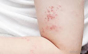 How Do I Choose The Best Cream For Rashes With Pictures