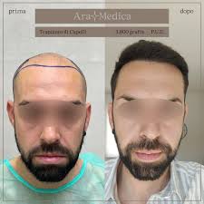 Transplantace vlasů Itálie