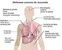 Jun 07, 2021 · l'intervista a today che cos'è la leucemia fulminante e perché è così difficile riconoscerne i sintomi, l'intervista all'ematologa. Leucemia Fulminante Que Es Causas Sintomas En Adultos Y Mas