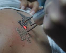Laser vein treatment is similar to laser tattoo removal in new jersey and helps people improve their personality. Best Laser Tattoo Removal Machine For You Aesthetic Laser Company