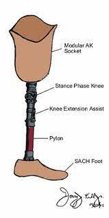Layanan pembuatan kaki palsu dan tangan palsu serta alat bantu orthopaedi di kota jambi kami menyediakan kaki palsu dan tangan palsu sesuai dengan kebutuhan pasien dan dikerjakan oleh tenaga profesi ahli dibidangnya yang sudah berpengalaman dan bersertifikat. 21 Kaki Palsu Ideas Thumb Splint Club Foot Baby Foot Orthoses