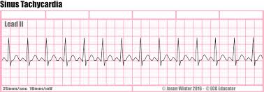 Ecg Educator Blog Six Second Ecg Rhythm Strips