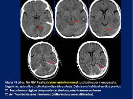 Esta enfermedad sucede cuando una de las arterias que suministra sangre al cerebro se estrecha, por lo general a causa de asterosclerosis, y el aporte sanguíneo al cerebro resulta tan precario que la sangre forma una coágulo en la porción. Figure 6 From La Trombosis Venosa Cerebral Un Reto Diagnostico Semantic Scholar
