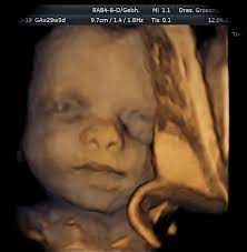 Our baby boy nicolai in 4d ultrasonic. 3d 4d Ultraschall Frauenarzte Hannover