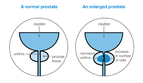 Enlarged Prostate Prostate Cancer Uk