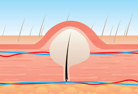 And on the other end, they consist of a small strand of hair trapped under multiple layers of skin. Ingrown Hair Removal Tips Treatment Treatment Prevention Causes