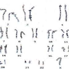 Herhangi bir belirti göstermeseniz bile aile geçmişinizde bu hastalık varsa hastalığı taşıyor olabilirsiniz. Sindromul Cri Du Chat Download Scientific Diagram