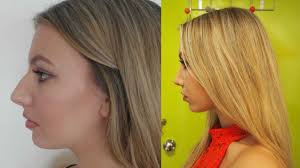 We did not find results for: To Anyone Considering Plastic Surgery Read This First