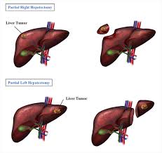 Done from a photo of a liver transplant. Virginia Surgery Associates Liver Surgery