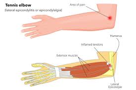 It causes pain in the backside of the elbow and forearm, along the thumb side when the arm is . Tennis Elbow Health Navigator Nz