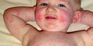 Bintik merah pada kulit bayi setelah beberapa hari demam. Jangan Terlambat Ditangani Ini Bedanya 3 Penyakit Dengan Gejala Ruam Dan Demam Pada Bayi Orami