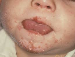 We did not find results for: Hand Foot And Mouth Disease Images Dermnet Nz