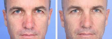 It has a powerful chilled tip cooling system to minimize pain and reduce the risk of burning. Dermatology Laser Treatments In Dayton Oh Dayton Skin Care