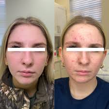 Summer skin is made in the winter! ❄️✨ Celebrating this snow week with this  incredible skin transformation ! Treatment plan details: 1. CONSISTENCY 2.  Custom @janmariniskinresearch 4 product AT HOME regimen With