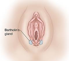 Caring for a bartholin's cyst does not need to be an arduous or painful process. Bartholin S Cyst No Infection