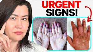 Image result for Connective Tissue Disorder