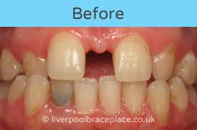Why do you need braces to close a tooth gap? Gaps Liverpool The Liverpool Brace Place