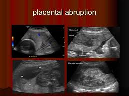 Placenta Ultrasound 32 638 Jpg 638 479 Pixels Ultrasound Sonography Diagnostic Medical Sonography Obstetric Ultrasound