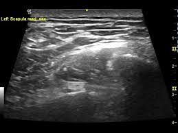 Image result for Scapulothoracic Injection