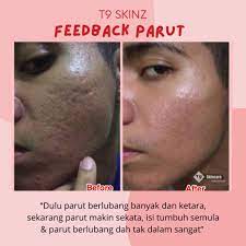 Terbaik untuk hilangkan parut jerawat berlubang di muka. Tips Rawatan Parut Berlubang Tanpa Laser T9 Skincare