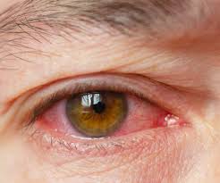 Image result for Vernal Conjunctivitis
