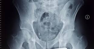 Unfortunately, every complaint or symptom of cancer can be explained by a harmless condition as well. What Are The Symptoms Of Pelvic Cancer