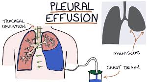 Image result for Pleural Tuberculosis