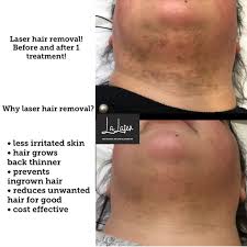 It's another method for pcos women to treat hirsutism (unwanted hair growth). La Laser Do You Have Polycystic Ovary Syndrome We Can Facebook