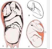 The affected foot appears to have been rotated internally at the ankle. Introduction To Clubfoot Physiopedia
