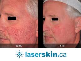 Comprehensive Guide to Age Spots Removal: Laser Treatment...