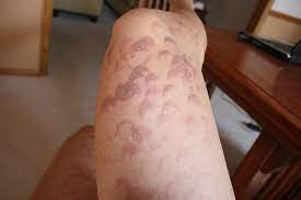 While follicular edema is normal after laser hair removal treatment, blistering (or more severe burns) or prolonged redness or brown discoloration after treatment are not. Burned Legs 065 Burns Received From Laser Hair Removal Siciliansun Flickr