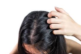 9 Natural Dandruff Remedies That Work Ethan Thomas Collection