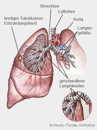 Die tuberkulose ist eine weltweit verbreitete bakterielle infektionskrankheit. Tuberkulose Tbc Ansteckung Symptome Therapie Netdoktor