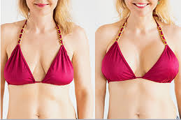 Best Breast Lift in Dubai - Mastopexy Surgery | Cost